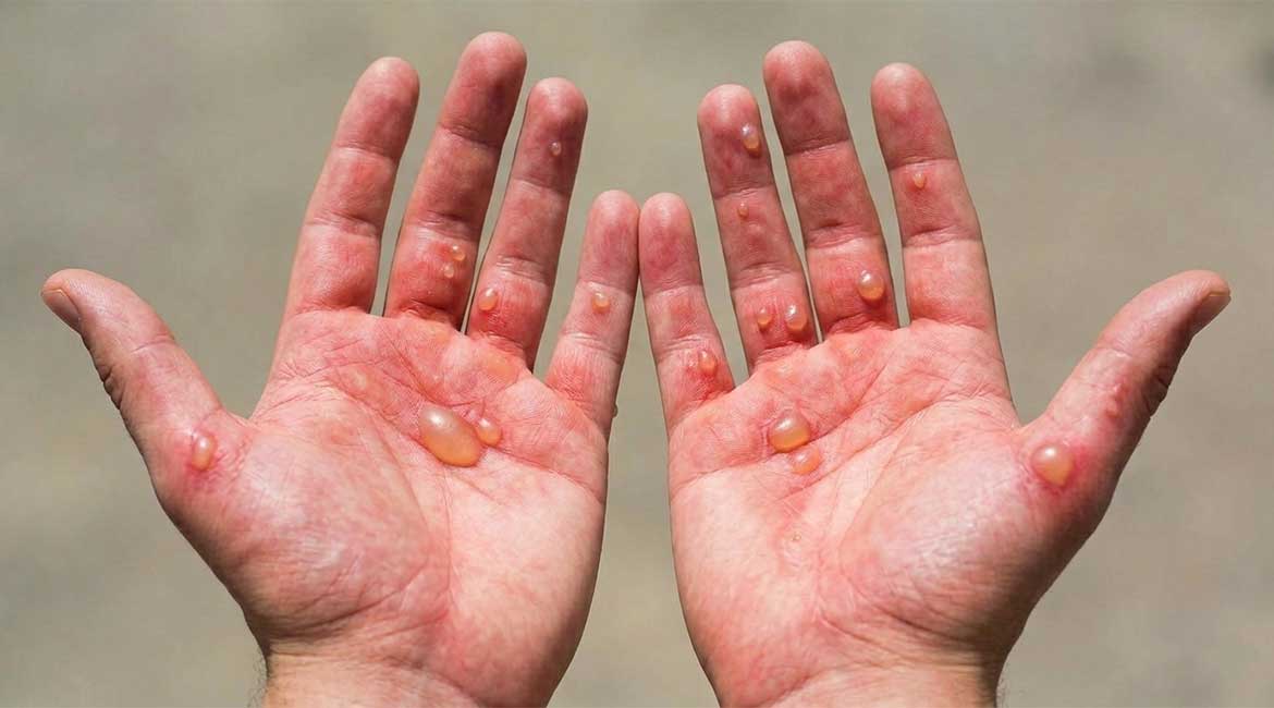 U dva vrtića u Beogradu proglašene epidemije šarlaha i streptokoke