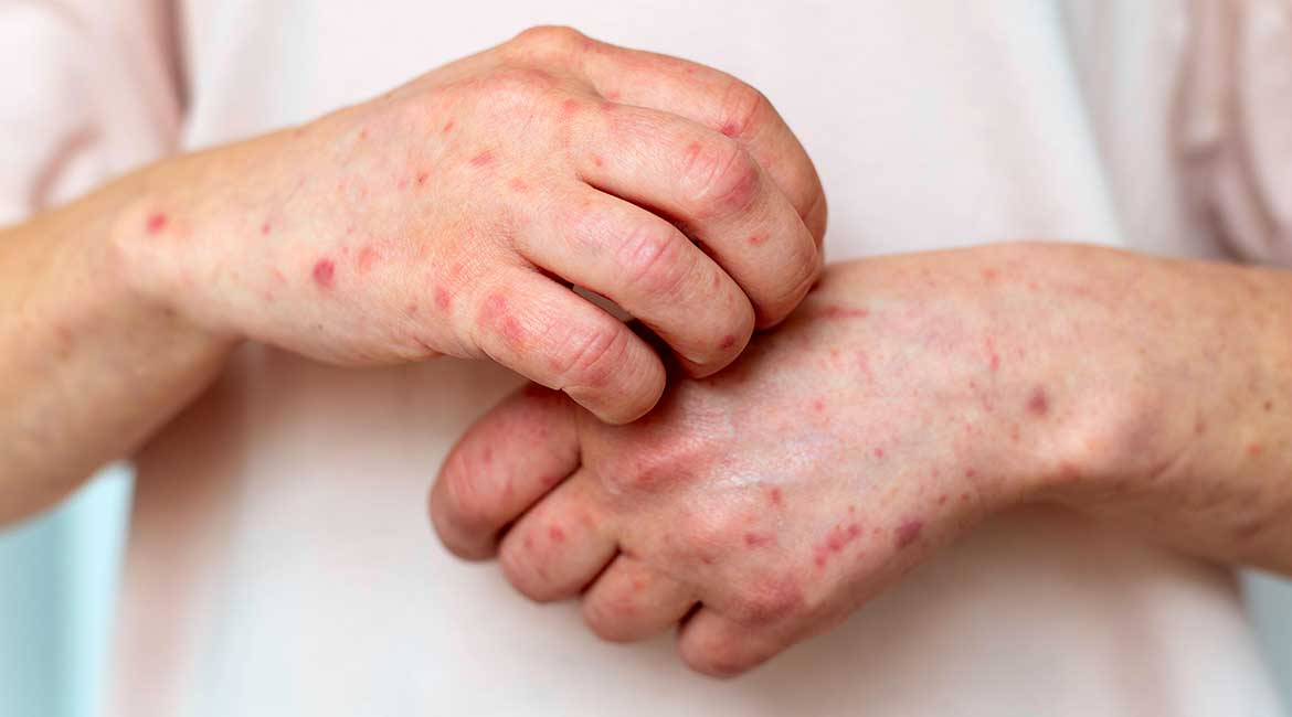 Mere pojačanog nadzora u celoj zemlji zbod malih boginja