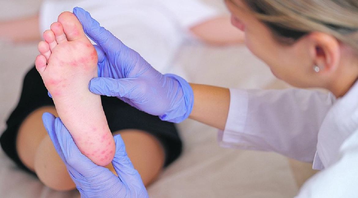 BRNU virus kod dece i kako ga lečiti