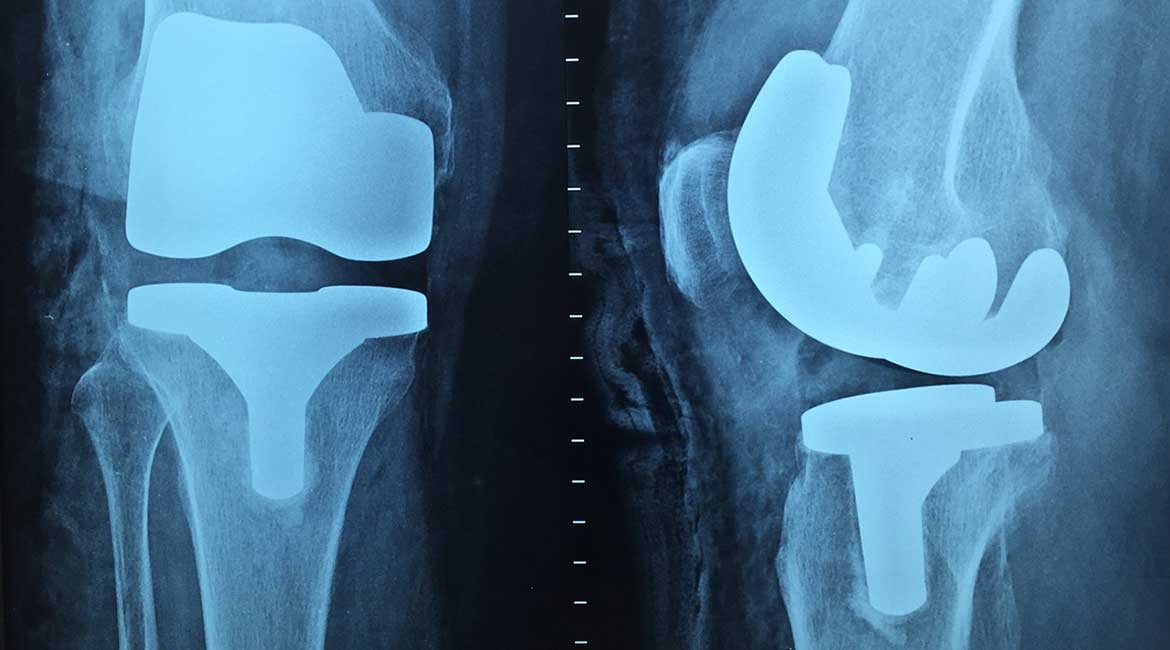 Prevencija i lečenje povreda kolena: Saveti za očuvanje zdravlja i brz oporavak