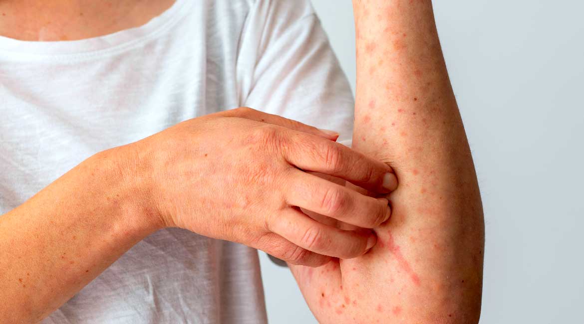 Varičela kod dece: Od prvog simptoma do odlaska na more